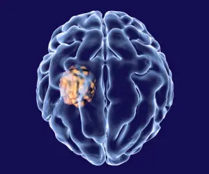 best-brain-infections-services-Miyapur, Hyderabad